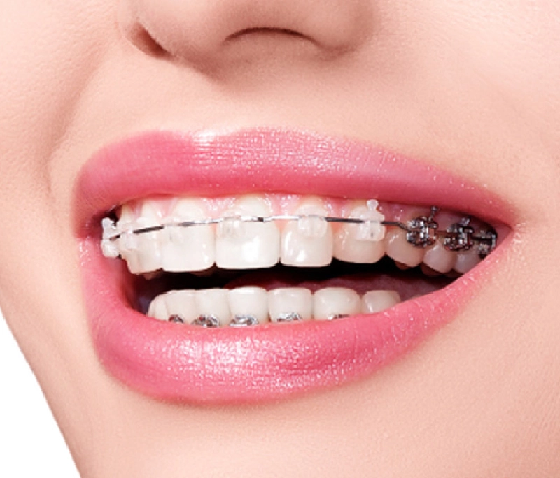 Răng bọc sứ có niềng được không?